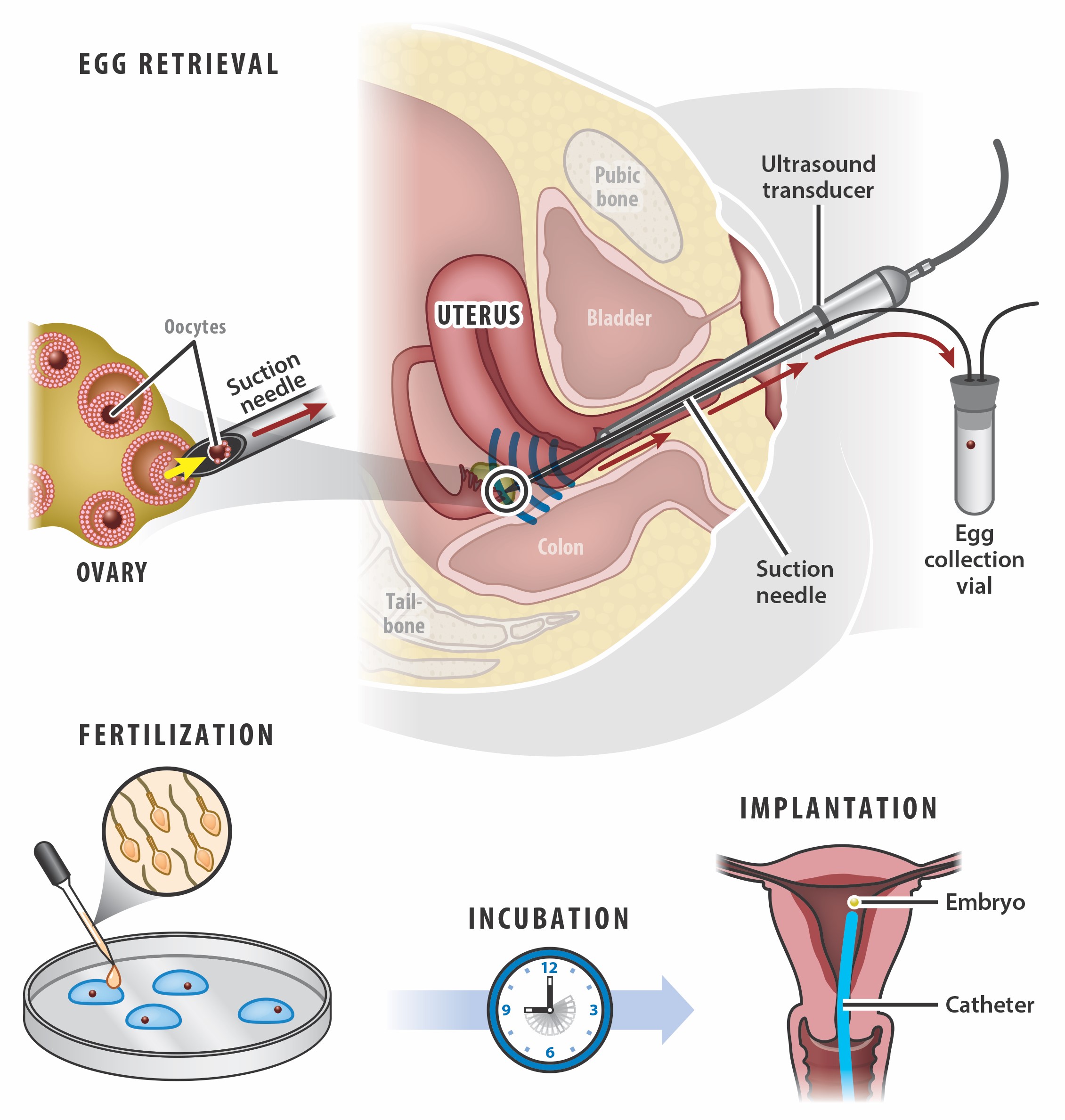 diagram showing the IVF process